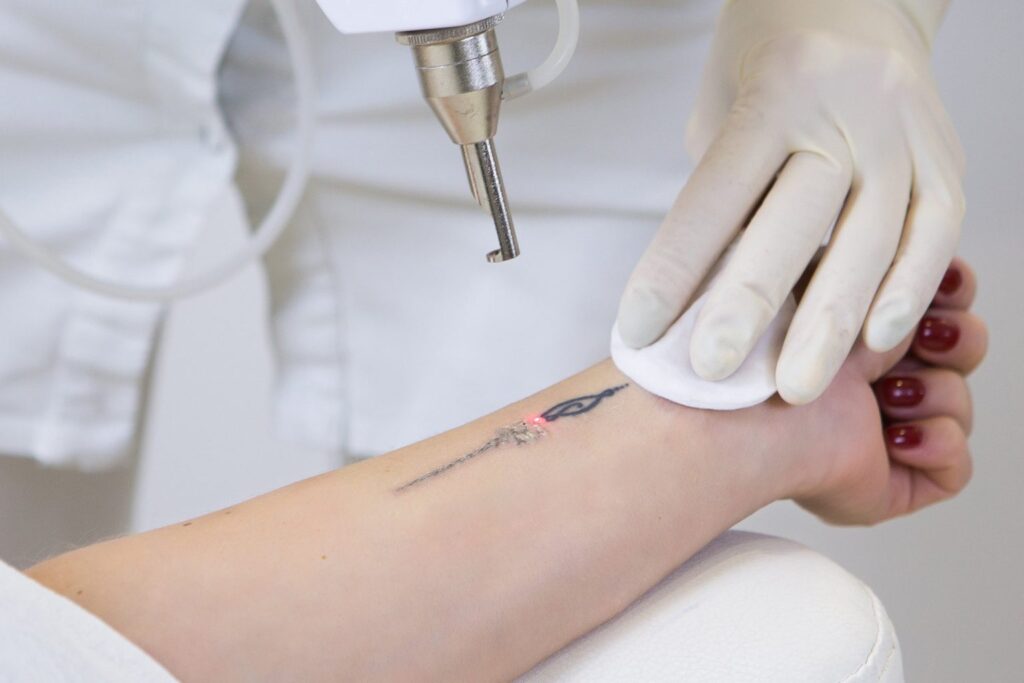 tatoveringsfjerning