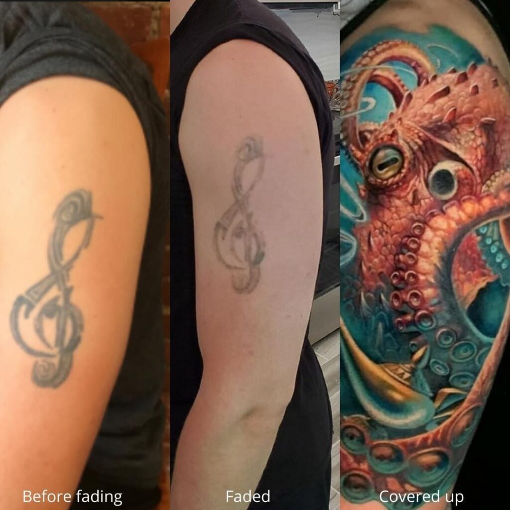 tatoveringsfjerning